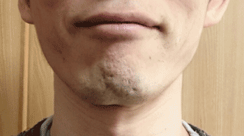 ダイエット後の顔